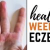 Weeping Eczema Overview and More