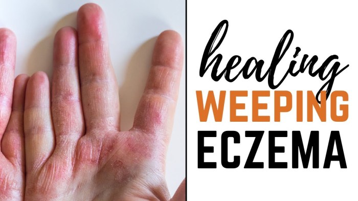 Weeping Eczema Overview and More