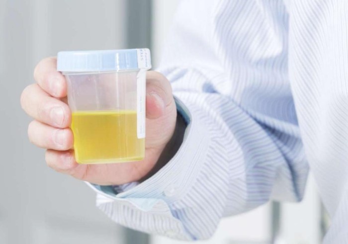 Urine Glucose Test What It Measures, Results, Next Steps
