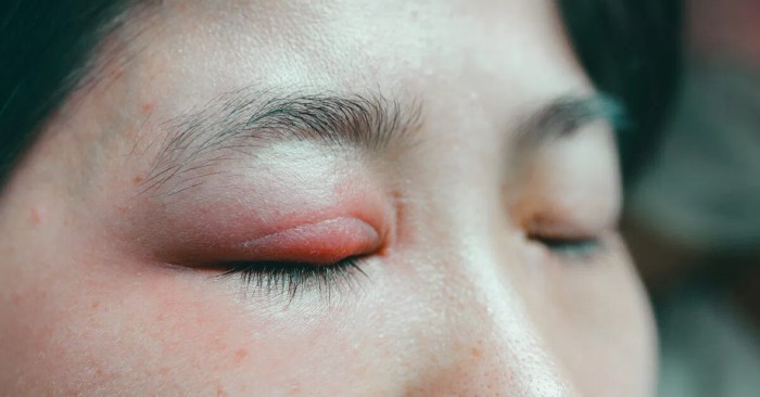 4 Ways to Quickly Treat a Mosquito Bug Bite on the Eyelid - YouMeMindBody Bug bite on eyelid