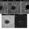 Macular Telangiectasia Type Two A Comprehensive Guide