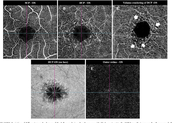 Macular Telangiectasia Type Two A Comprehensive Guide