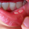 Canker Sore on Tongue A Comprehensive Guide