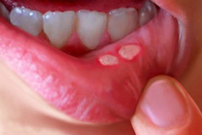 Canker Sore on Tongue A Comprehensive Guide