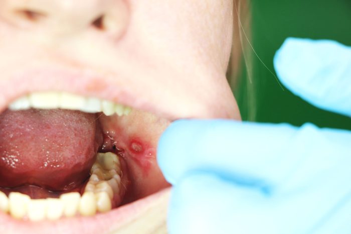 Canker sore on tongue