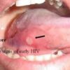 HIV Mouth Sores Pictures Visual Guide