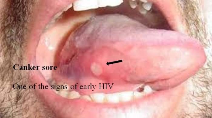 HIV Mouth Sores Pictures Visual Guide
