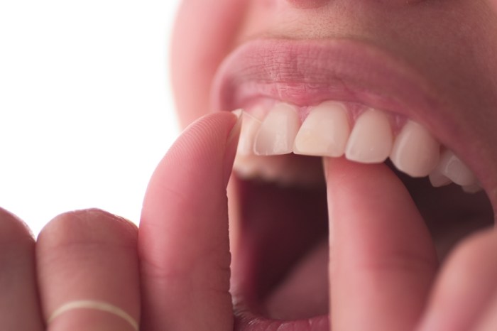 Hiv mouth sores pictures