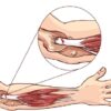 Surgery for Tennis Elbow A Comprehensive Guide