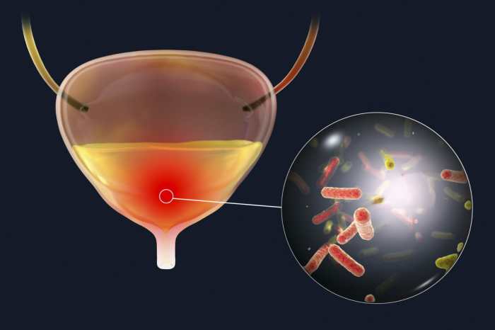 A new oral antibiotic for uti