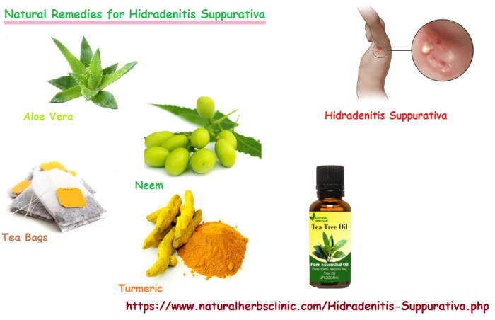 Natural Home Remedies For Hidradenitis Suppurativa - Health, Beauty ... Hidradenitis suppurativa home remedies