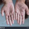 Drool Rash vs Hand-Foot-Mouth A Deep Dive