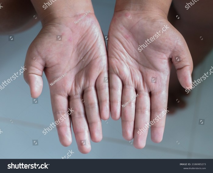 Drool rash vs hand foot mouth