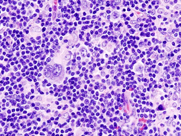 Mixed cellularity Hodgkin's Lymphoma. Hodgkin cells are seen admixed ... Mixed cellularity hodgkins lymphoma