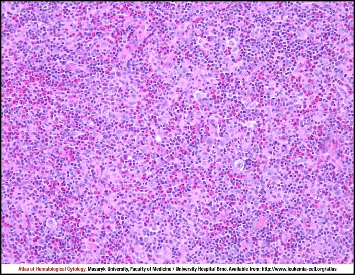 File:Hodgkin lymphoma (1) mixed cellulary type.jpg - Wikipedia Mixed cellularity hodgkins lymphoma