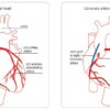 What is Quadruple Bypass Heart Surgery? A Deep Dive