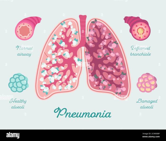 Pneumonia and covid 19