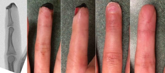 Fingertip Injuries - East Bay Hand Medical Center - Best Hand Surgeons Fingertip injury will tip grow back