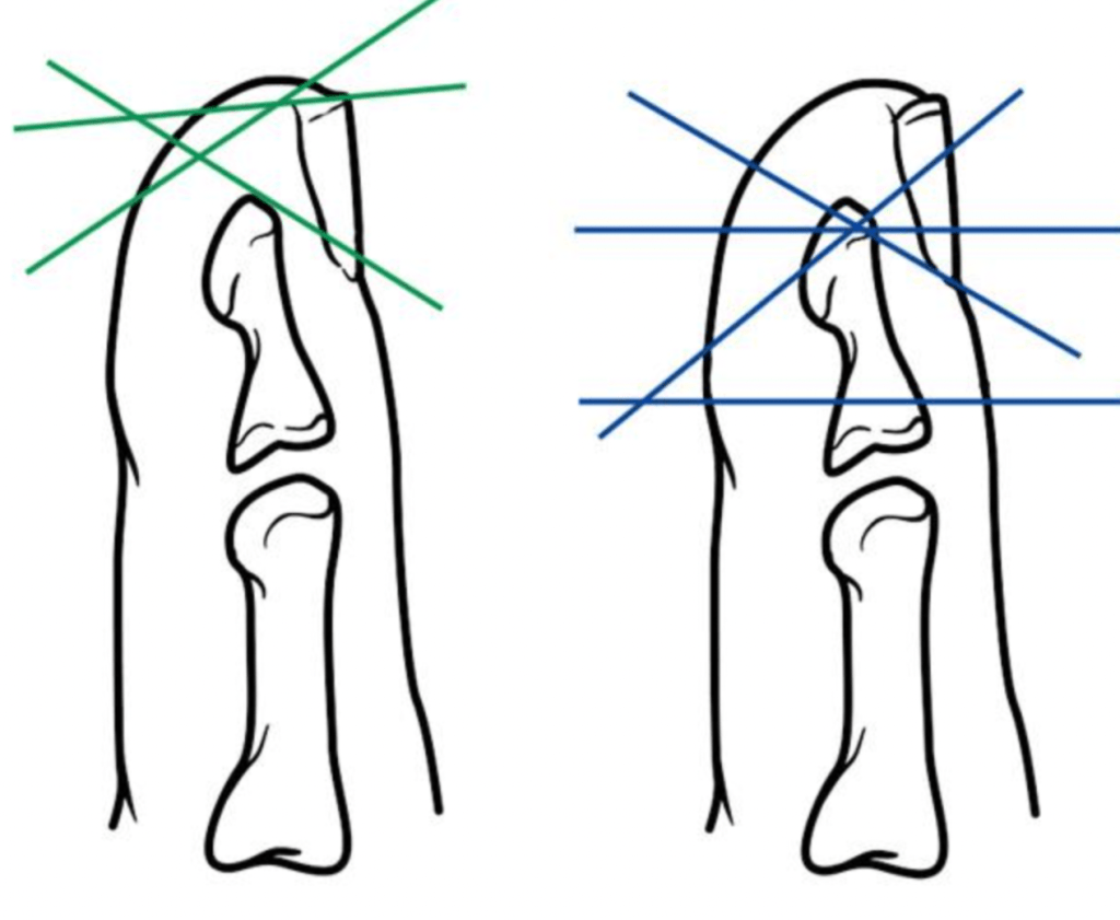 4 Common Fingertip Injuries - Athletico Fingertip injury will tip grow back