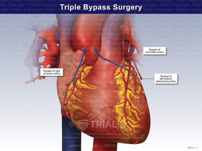 Triple bypass surgery day of surgery