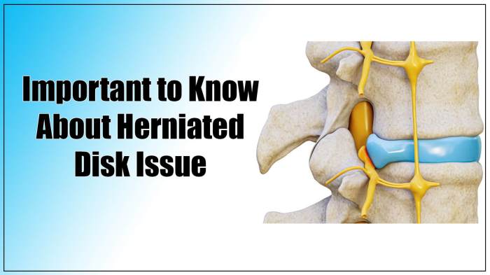 Herniated disc physical therapy