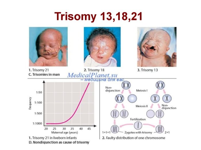 Patau syndrome trisomy 13