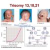 Patau Syndrome Trisomy 13 A Comprehensive Guide