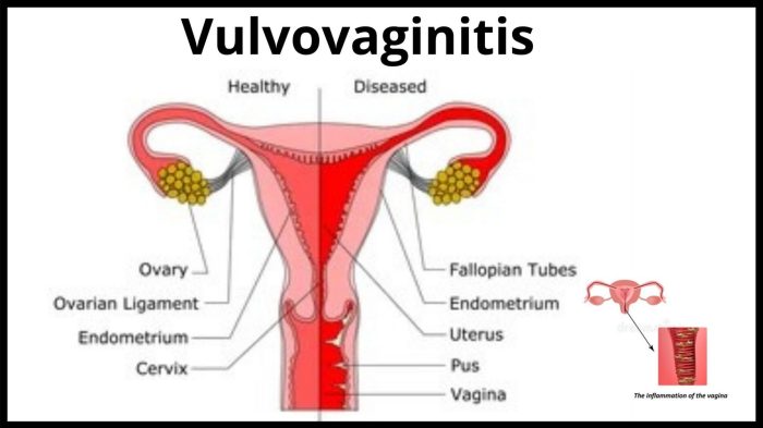What does vulvovaginitis look like
