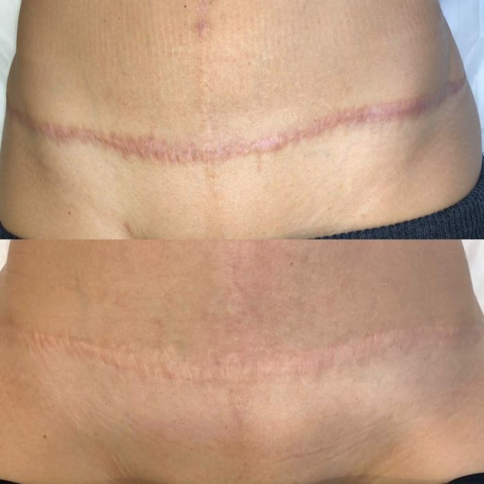 C section scar healing stages