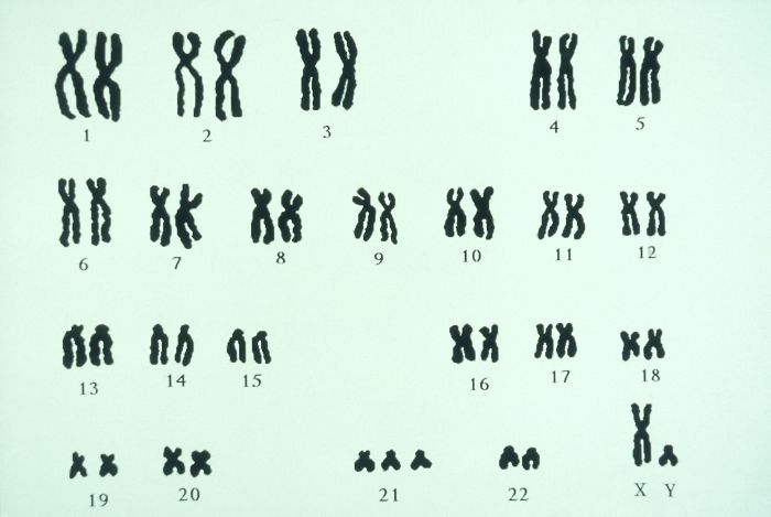 Patau syndrome trisomy 13