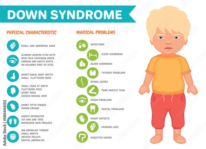 Symptoms of down syndrome