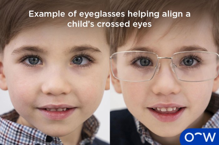Illustration of a child with various strabismus types: esotropia ... Esotropia crossing of the eyes