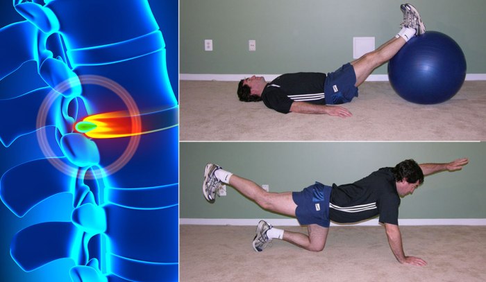 Exercises for herniated disc