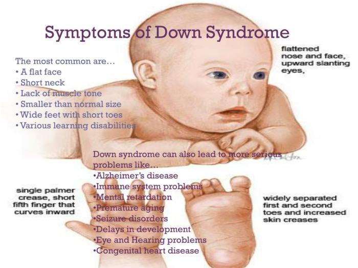 Symptoms of down syndrome
