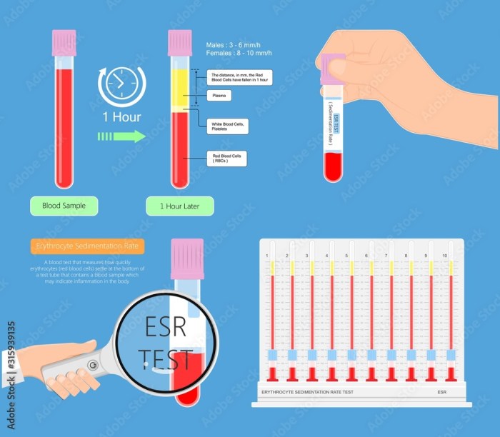 Sedimentation rate what does it tell about arthritis