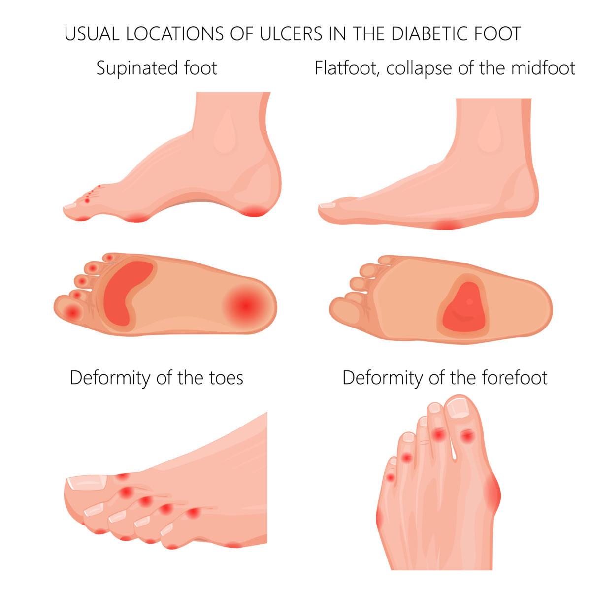 Bacterial infections of the feet and toes