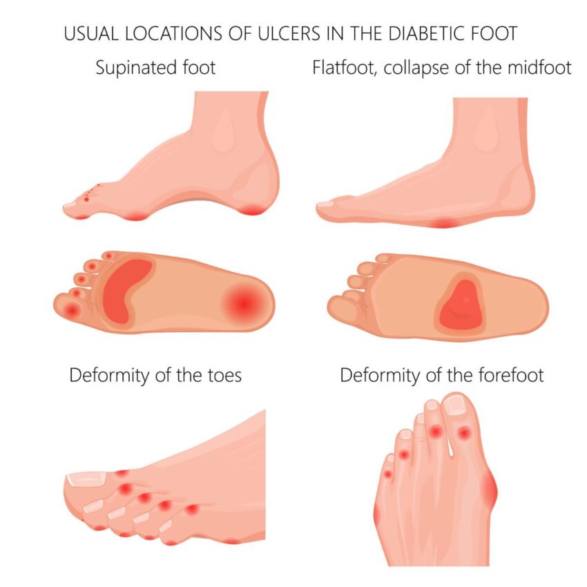 Bacterial infections of the feet and toes