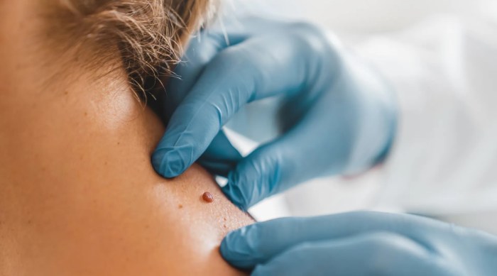 How to remove skin tags at home