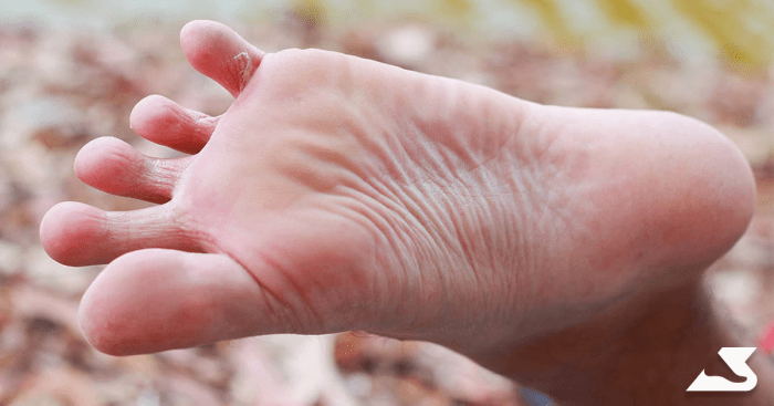 Bacterial infections of the feet and toes